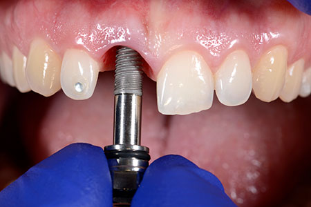 Implante dentário único